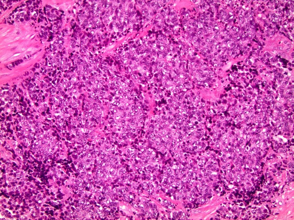 Prostatic neuroendocrine adenocarcinoma image. Courtesy of PathologyOutlines.com.